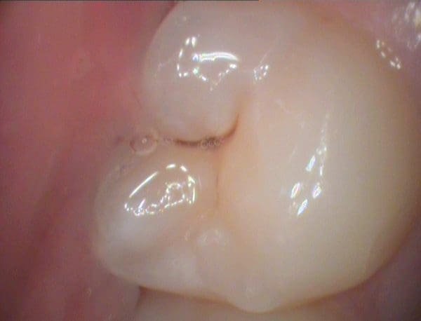 CamX Elara Intraoral Camera - Air Techniques: Elaratooth1 600x458