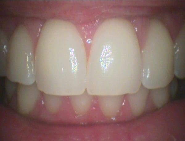 CamX Elara Intraoral Camera - Air Techniques: Elaratooth3 600x458