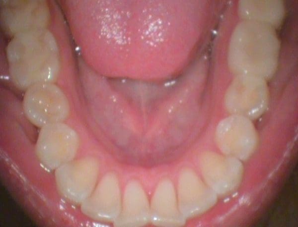 CamX Elara Intraoral Camera - Air Techniques: Elaratooth4 600x458
